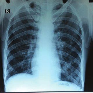 apicolordotic view treatment|Pediatric Chest Disorders: Practical Imaging .
